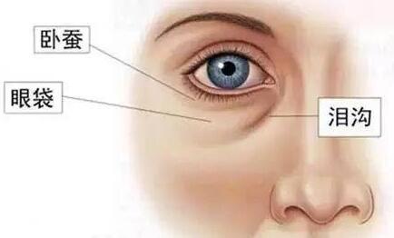 泪沟是什么？如何有效的祛除泪沟？