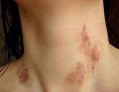 情侣之间种草莓的含义是什么？情侣之间种草莓的危害