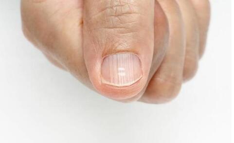 指甲有竖纹 指甲上有竖纹是怎么回事