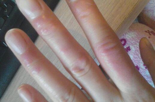 天气热手上起小水疱疹怎么办夏天要小心汗疱疹