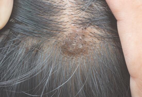 头上长包是癌症前兆吗 应该怎么预防它