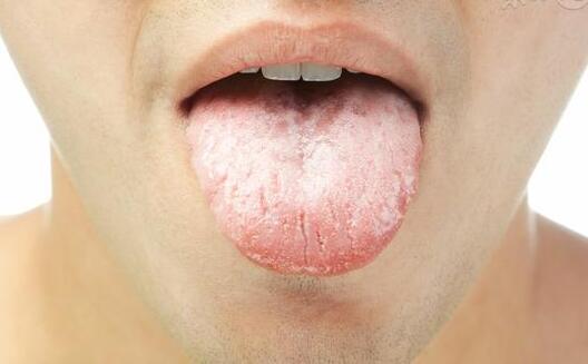 舌头颜色变化可以预示8种疾病