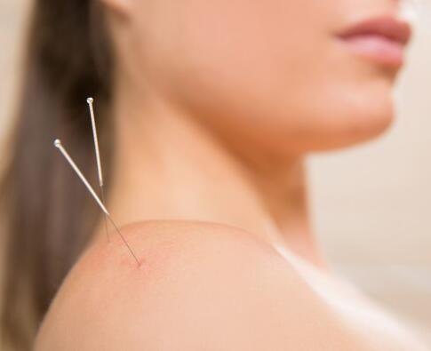 针灸放血去湿气 这种方法是否有效