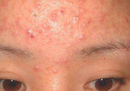 春天来了 螨虫过敏复发了吗