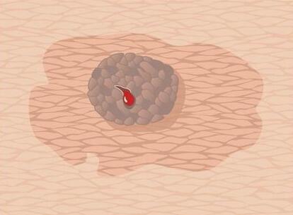 身上的痣真的会演变成皮肤癌吗 怎样的痣需要特别注意呢