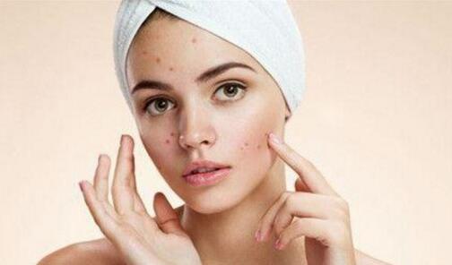 脸上痘印如何祛除 脸上痘印怎么最快淡化