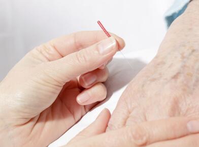 中医针灸疗法是如何让患者摆脱痛风的