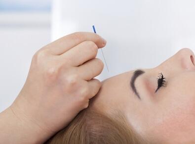 中医针灸可以帮助女人美容养颜