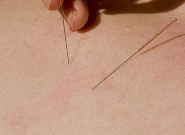 针灸会不会感到疼痛 要预防哪些意外事情的发生
