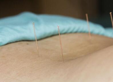 针灸减肥常见的方法有哪些 有哪些注意事项