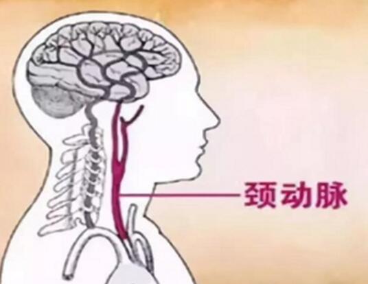 女性如何预防中风 现在中风已经逐年呈年轻态势