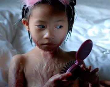 烫伤后护理很重要 水泡要不要挑破