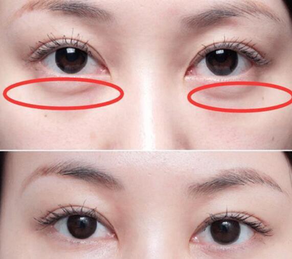 怎么去眼袋 一旦形成能消除吗