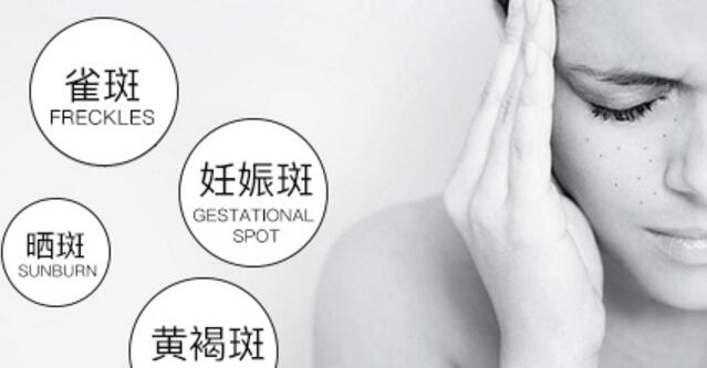 脸上长有黄褐斑怎么治疗?教你科学祛斑