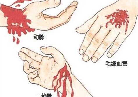 毛细血管扩张怎么办呢 常见的治疗方法又有哪些呢