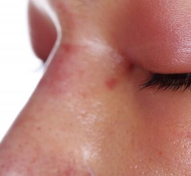 治疗红鼻子偏方 这些方法简单又有效