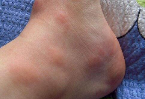 全身过敏起红疙瘩痒连成一片怎么办