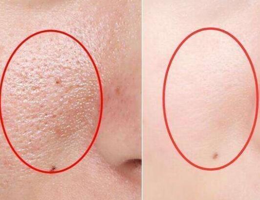 教你摆脱月球脸 红痘黑印都是浮云