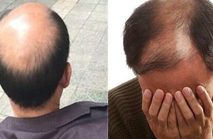 头发一天不洗就出油 一洗头就大把的掉头发