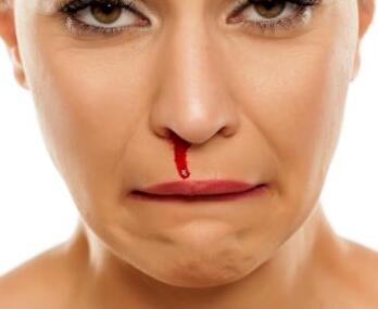 鼻子出血的时候 应该怎么止血呢