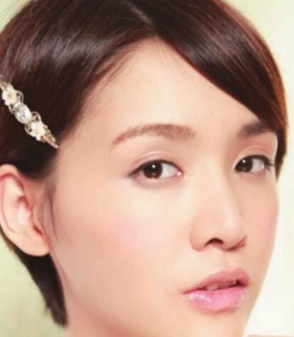 激光祛斑疼吗 激光祛斑是什么原理