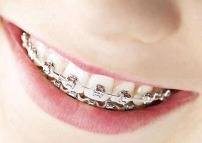 戴了戴牙套能接吻吗 牙套会不会影响接吻