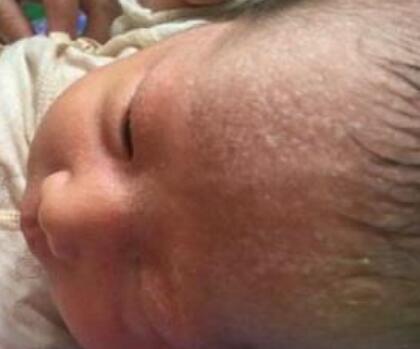 恼人的痱子 对于婴儿产生热痱的护理