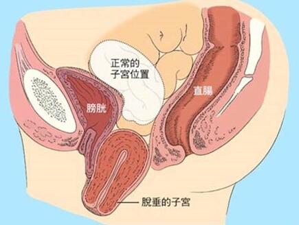 子宫脱垂是什么意思 子宫脱垂的原因是什么