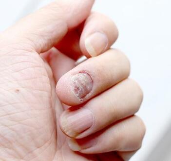 手指甲出现竖纹是什么情况