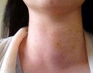 甲状腺结节是良性就不用治疗了吗 会不会癌变