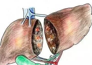 肝脏功能开始衰退 身体会出现一些求救信号