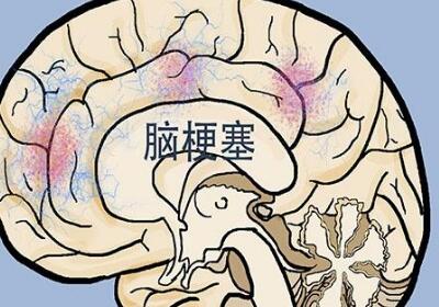 出现了脑梗还能恢复正常吗