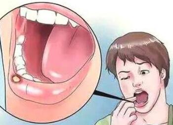 口腔溃疡有什么症状 口腔溃疡是口腔癌变的前兆吗