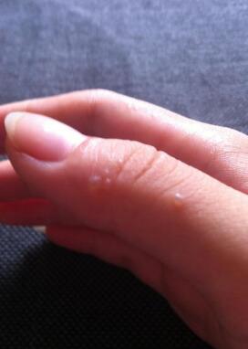 夏天手上起小水泡到底是什么？有什么办法祛除？