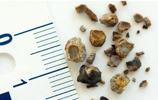 肾结石要多喝水 多注意饮食 谨记做好这两点 能让肾变好