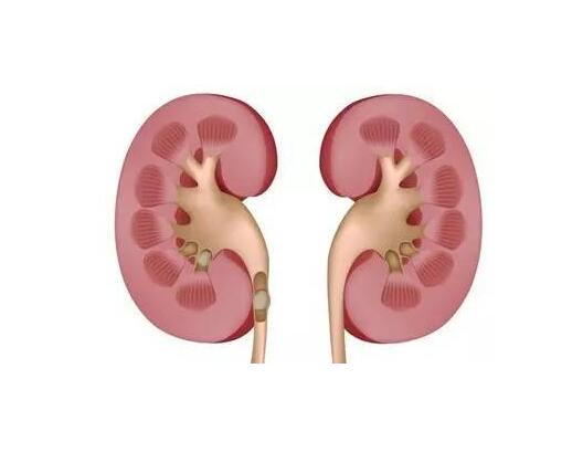 肾结石的症状-肾结石的鉴别和缓解方法