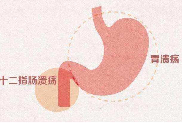 胃溃疡的病变与胃溃疡的注意事项