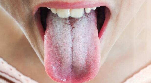 舌头上突然发白，到底是身体哪里出问题了？如何祛除体内湿气