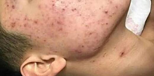 太阳穴和脸颊长痘痘，怎么注意调理以及注意事项