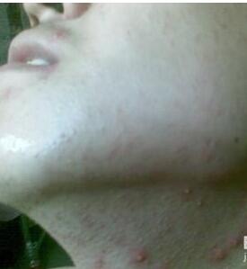 脖子上面长痘痘的原因 挤完痘痘后怎么处理