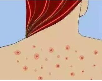 后背长痘痘什么原因 罪魁祸首竟然是它！后背长痘痘怎么办