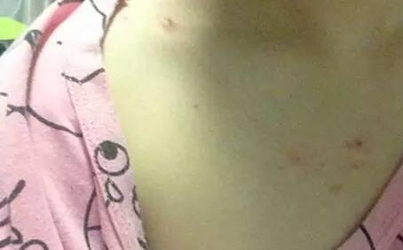 为什么胸上会长痘痘 教你几招解决小尴尬