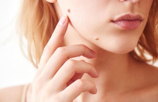 引起下巴长痘的原因是什么？如何预防长痘