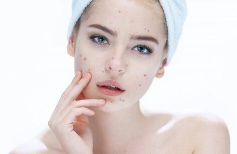 嘴角起痘痘影响美观又难受 是什么引起的 饮食上要注意哪些