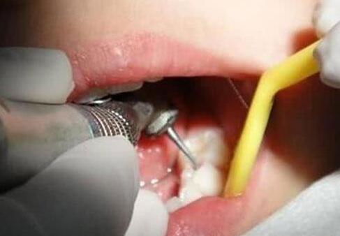 打响牙齿保卫战：几个常见的护牙误区，你中过几个？