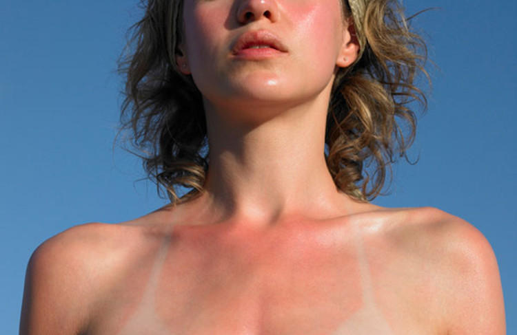 十分钟教会你如何紧急修复晒伤