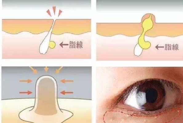 脂肪粒是什么 为什么那么难祛掉