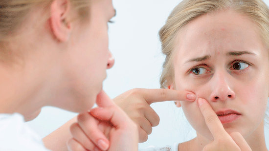 脸上长痘该怎么办 果酸换肤的这些情况你必须知晓