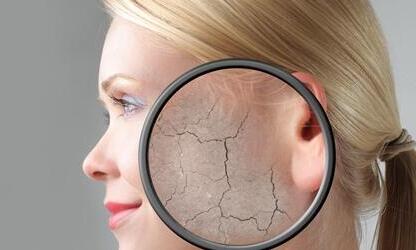 皮肤干燥起皮怎么办啊 皮肤干燥起皮的解决办法