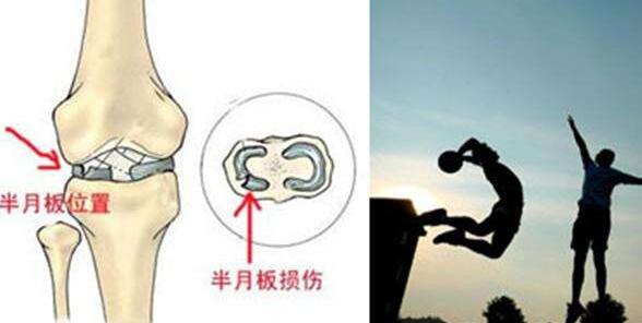 膝关节半月板损伤有哪些表现 半月板损伤后能否运动？